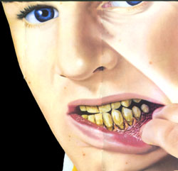 Receding gumlines and stained teeth caused by smoking cigarettes.